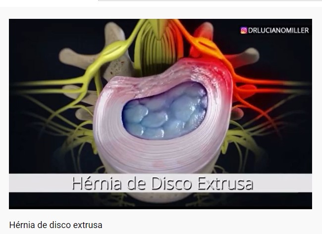 https://www.colunar.com.br/wp-content/uploads/2021/03/Hernia-de-Disco-Extrusa.jpg